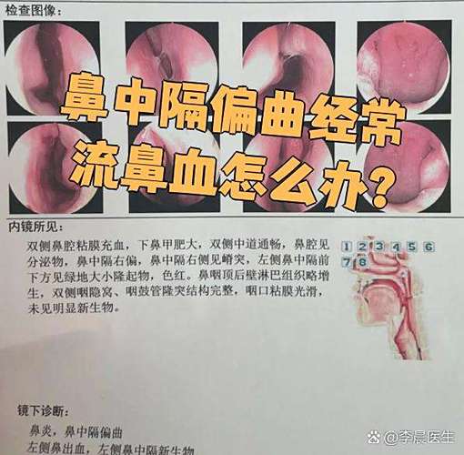经常流鼻血是什么问题缩略图