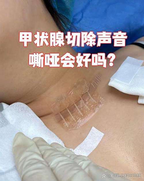 甲状腺切除声音嘶哑多久恢复