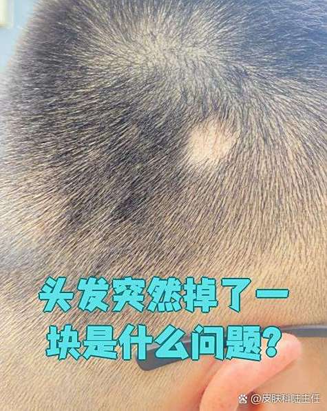 头发有一块地方掉光了为什么截图