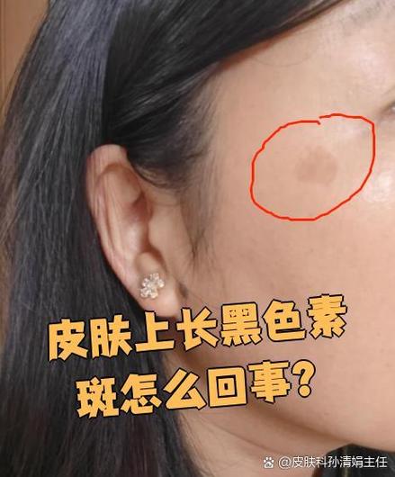 色素沉着斑