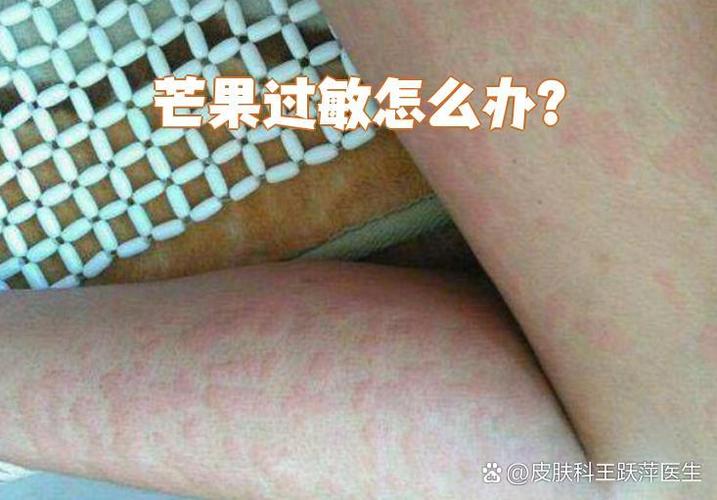 吃芒果过敏怎么办