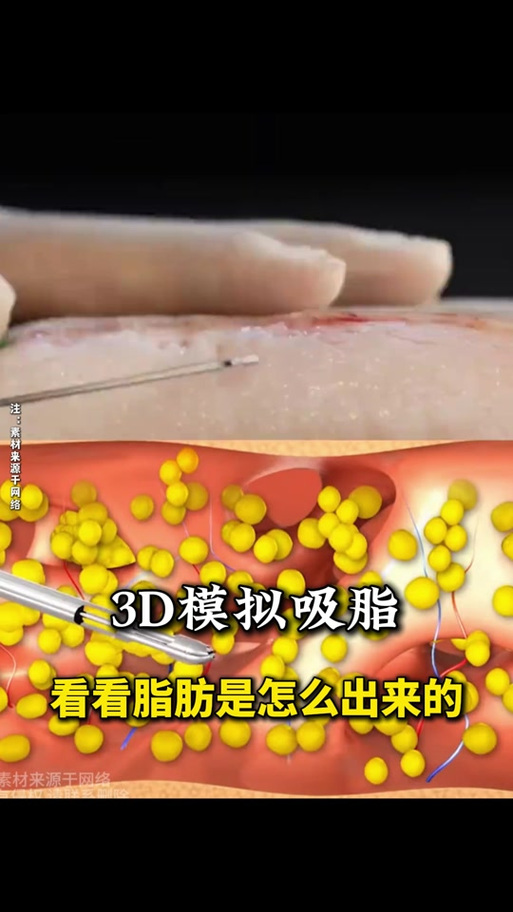 脂肪排出来啥样子
