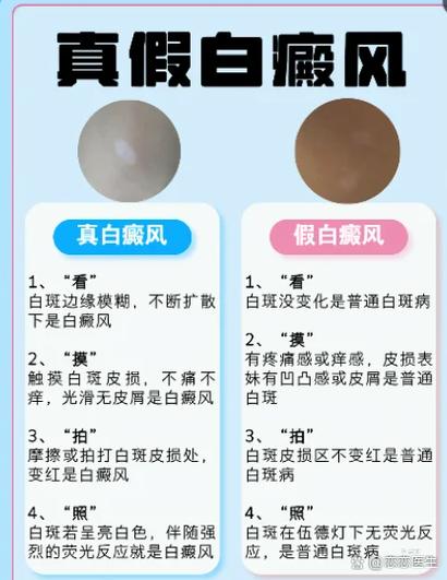 白斑和白点癫风有啥区别