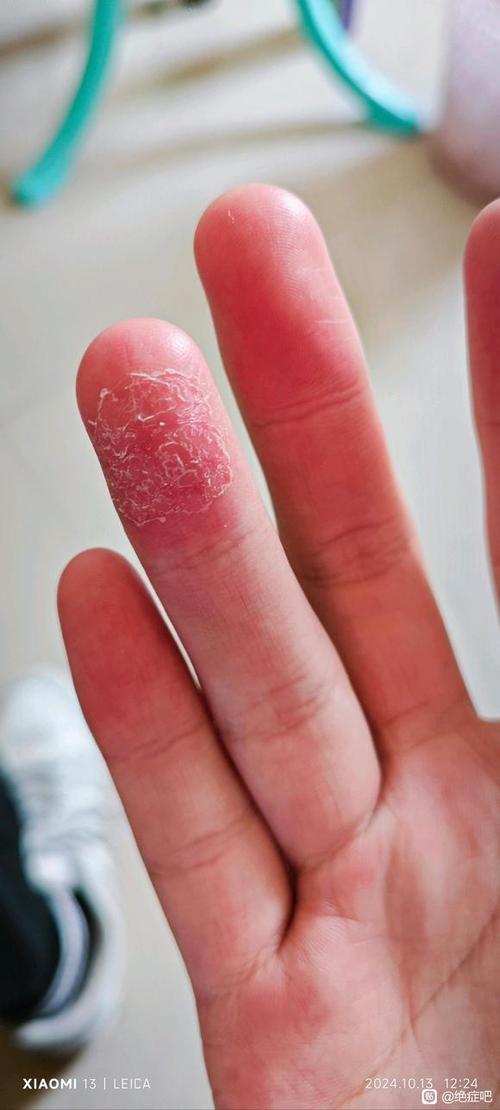 手指纹磨坏了还能长吗图标