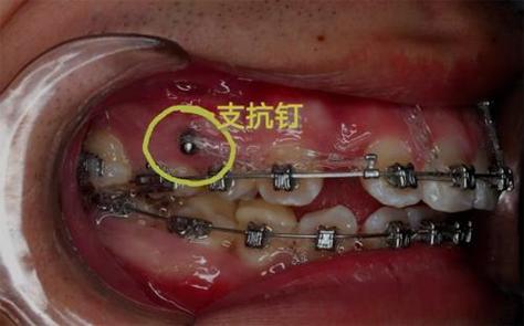 正畸骨钉周围有白色的膜