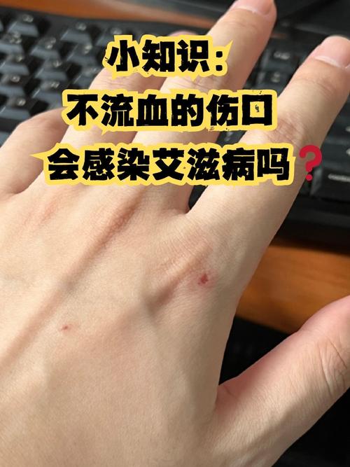 购买艾滋病检测试纸