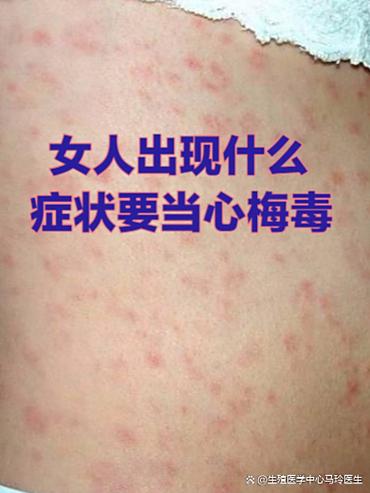 女人梅毒是什么症状