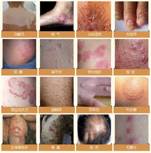 100种皮肤病对照图截图