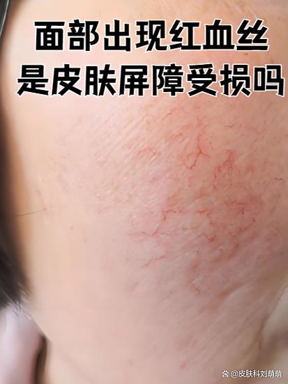 红血丝什么原因造成的