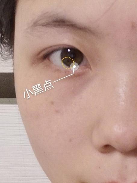 眼睛里的黑点怎么消除截图