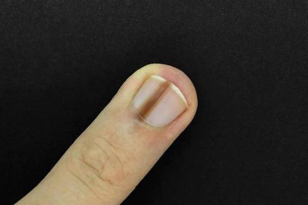指甲黑色竖纹是什么病