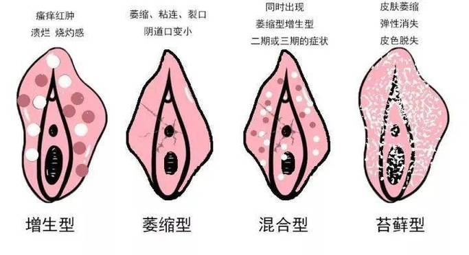 目前外阴白斑最好的治疗方法