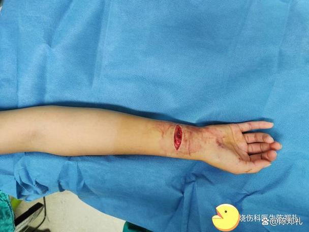 水果刀能割破手腕吗