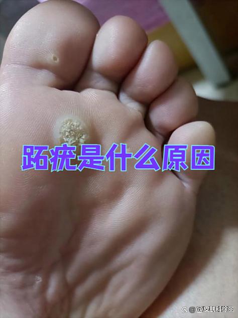 血脉粗的原因是什么