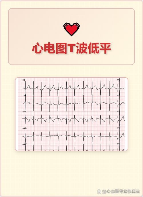 心脏t波低平严重吗