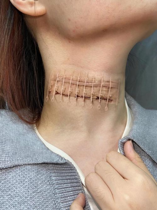 脖子裂缝怎么消除