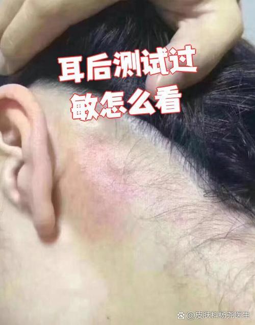 过敏什么样子图片
