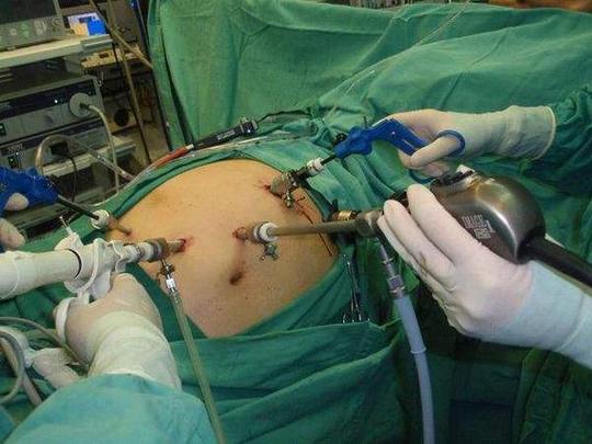 腹腔镜手术