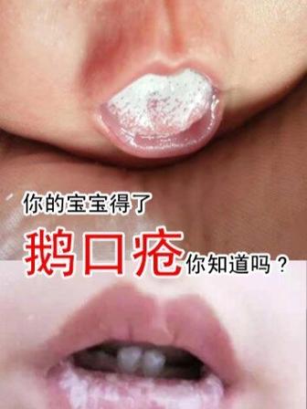 鹅口疮一般几天恢复