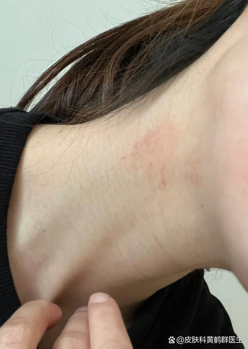 脖子上出现红斑块很痒