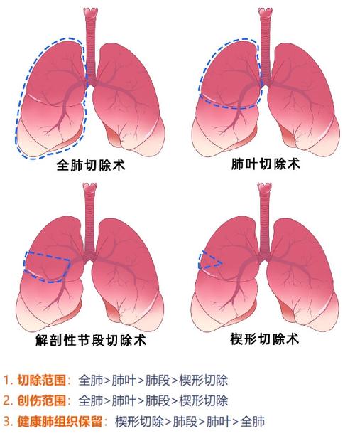 肺部肿瘤治疗方法