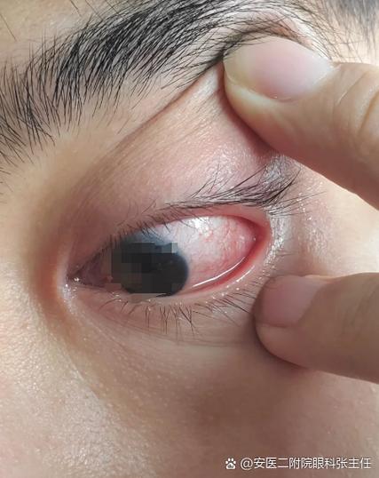 眼睛磨得慌有异物感