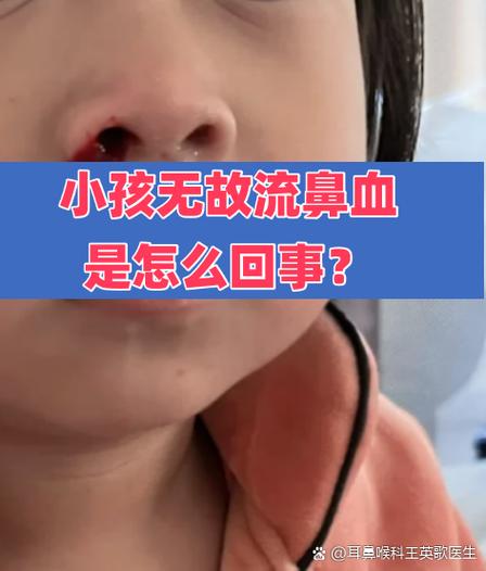 无故流鼻血是咋回事