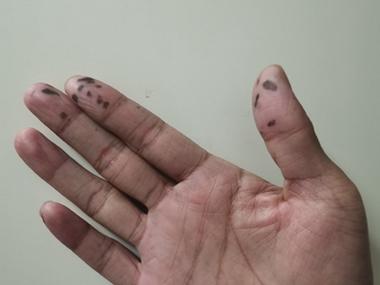手指甲里有针尖大小黑点截图