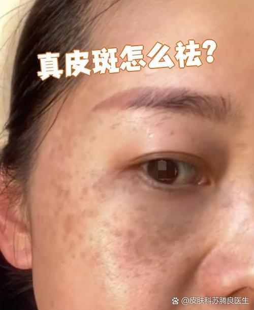 深层斑能彻底祛除吗