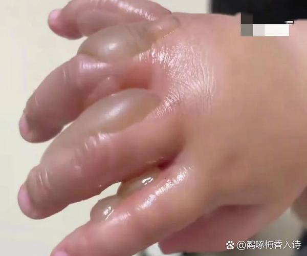 手烫泡了怎么处理方法