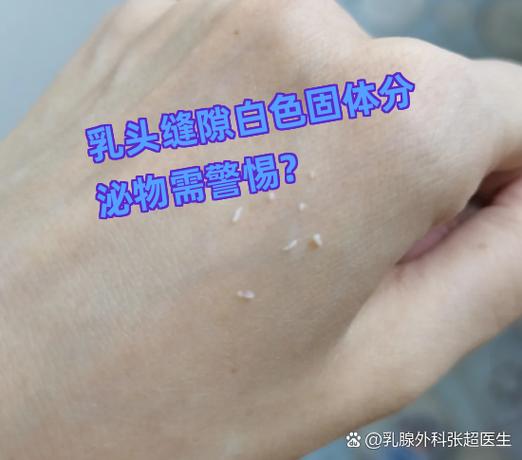 乳头有白色污垢有点臭截图