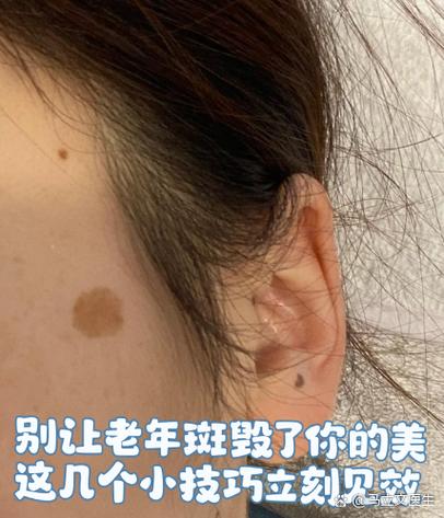 老年斑怎么能处理掉