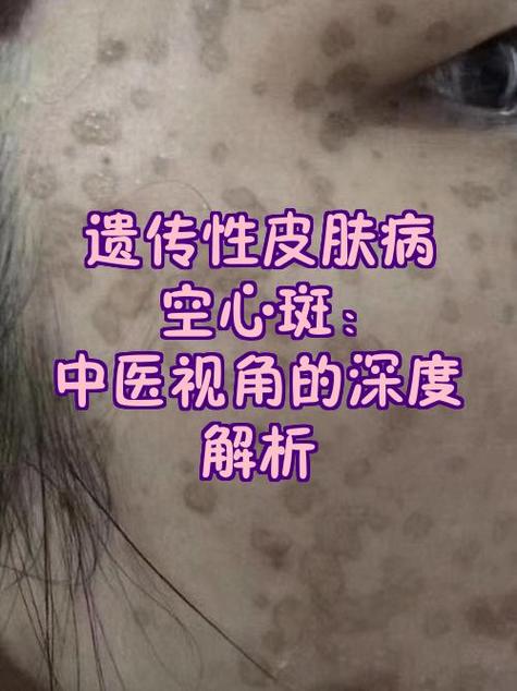 空心斑是什么原因导致的