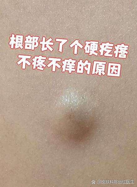隐私位置长了个硬疙瘩