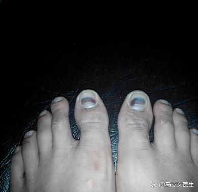 指甲有黑色竖纹是肝病吗图标