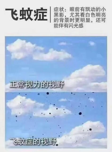 飞蚊症是什么原因造成的