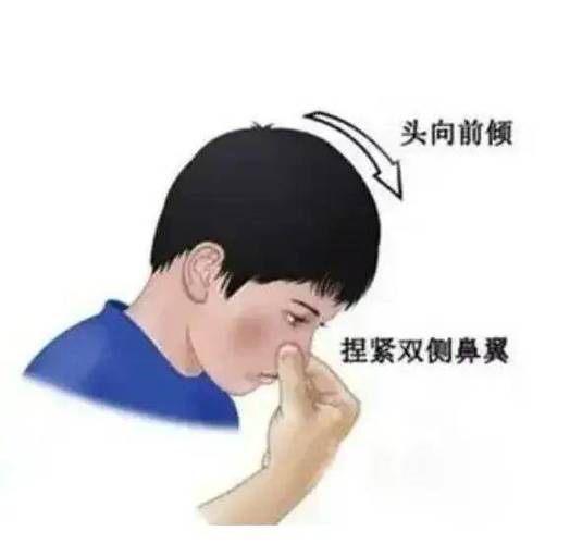 流鼻血站着还是坐着图标