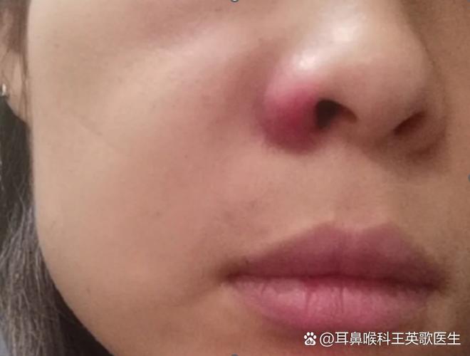 鼻子长痘红肿一碰就疼怎么消除