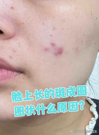 脸上有圆形斑要警惕