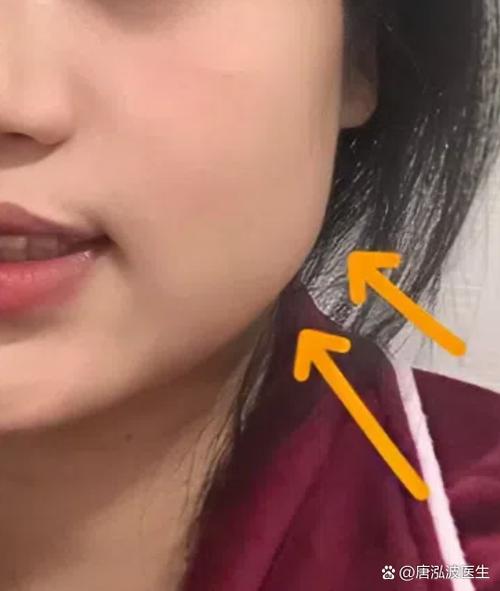 打瘦脸针21天咬肌软了脸没瘦
