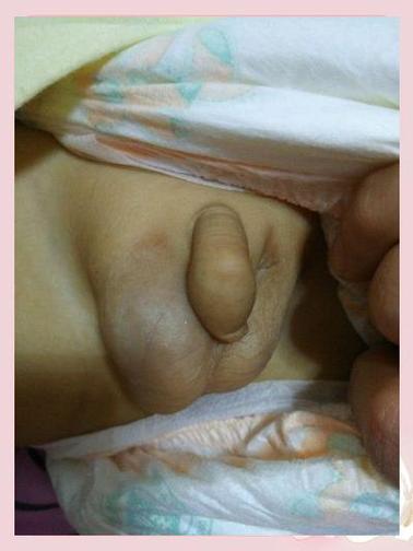 男性睾丸一大一小正常吗