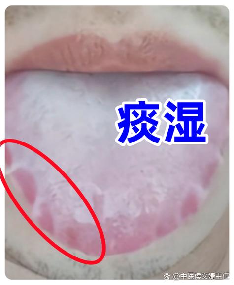 肉桂粉越吃湿气越重吗