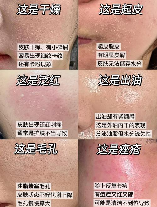 脸红角质层薄怎么治