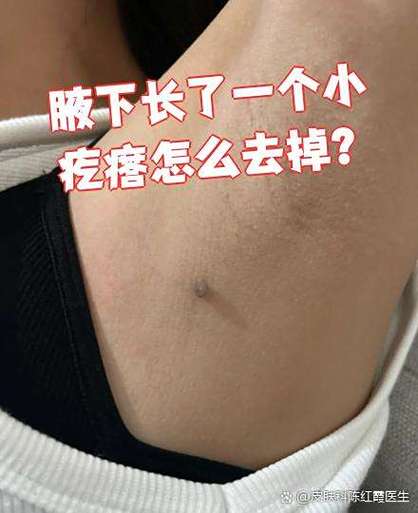 腋下长了个小疙瘩不痛不痒