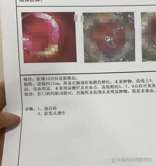 大便擦干净了过段时间后肛门又有大便