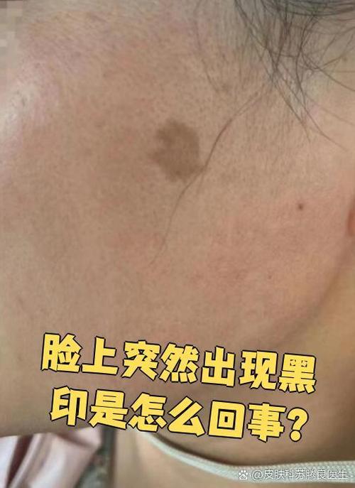 脸上一块黑印跟脏一样截图