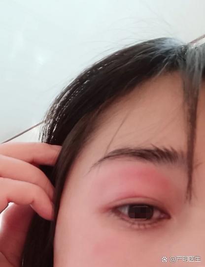眼睛周围过敏了又红又痒怎么办