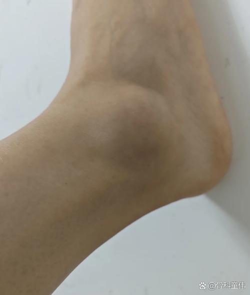 男人脚肿了预示着什么