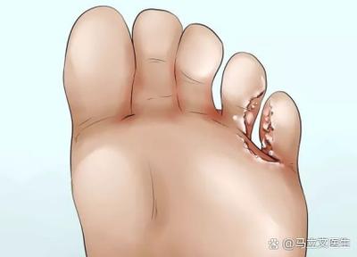 脚发痒挠了起疙瘩