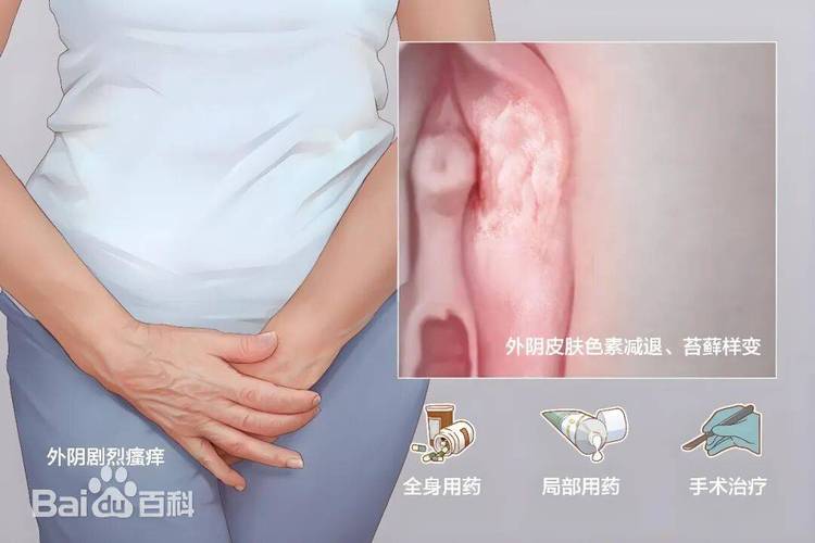 外阴白斑还能同房吗
